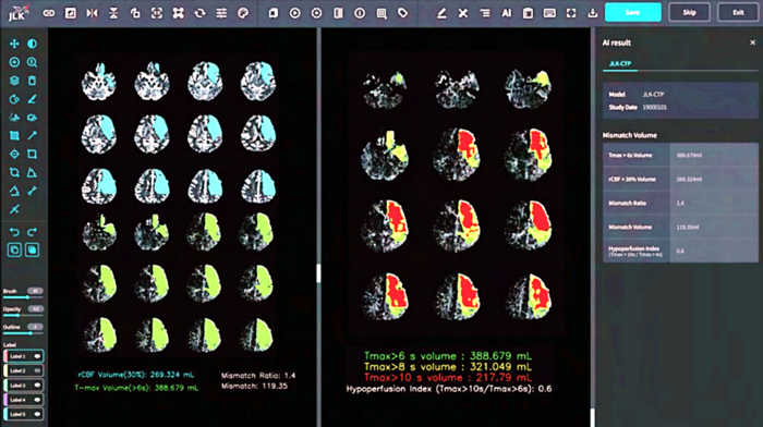 뇌 관류영상 분석 AI 솔루션 JLK-CTP