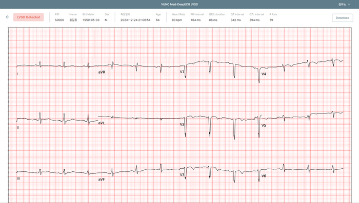 뷰노메드 딥ECG LVSD