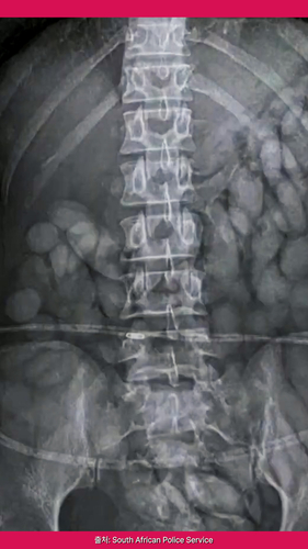엑스레이에 찍힌 이건 뭐지? [숏폼]
