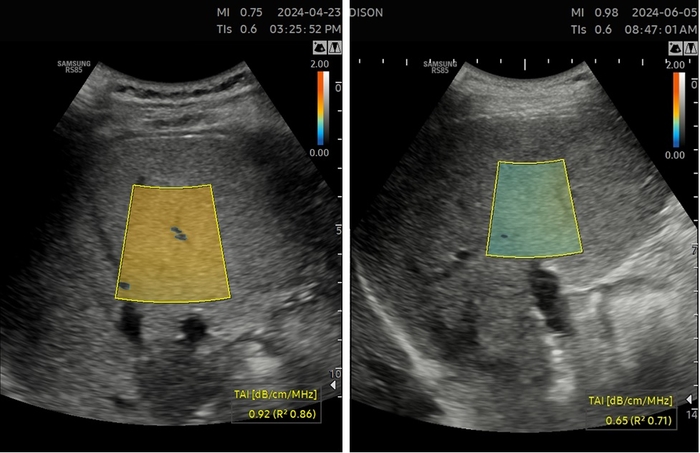 삼성메디슨의 '티에이아이(TAI™, Tissue Attenuation Imaging)로 촬영한 지방비율 18.5%의 중증 지방간(좌)과 관리 후 재측정한 지방비율 7.8%의 경미한 지방간(우)