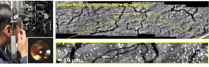 사람 대상 결막 술잔세포 영상화 검사 장면과 획득한 대면적 술잔세포 영상