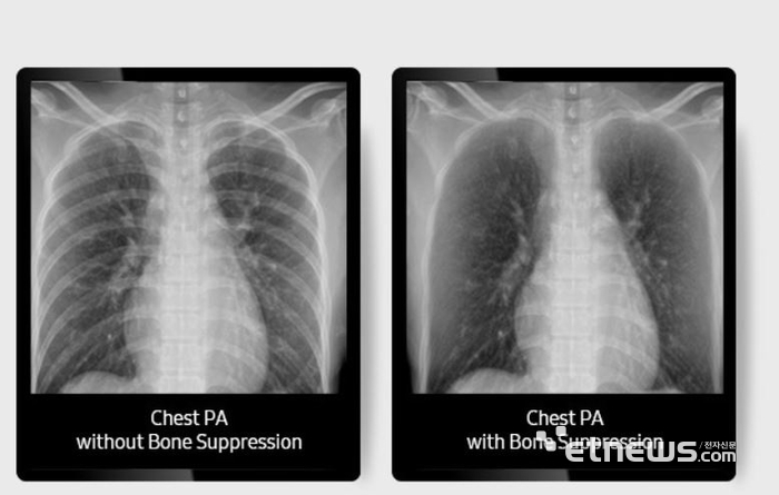 삼성전자, 8년 만에 디지털 엑스레이 신제품 선보인다