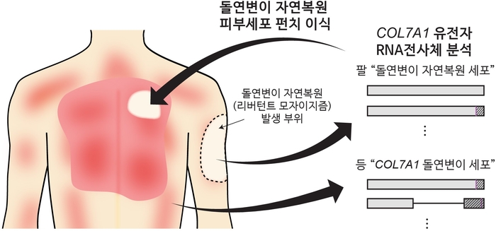 RDEB 환자 대상 유전자 돌연변이 자연 복원 피부세포 자가이식 치료 과정 모식도