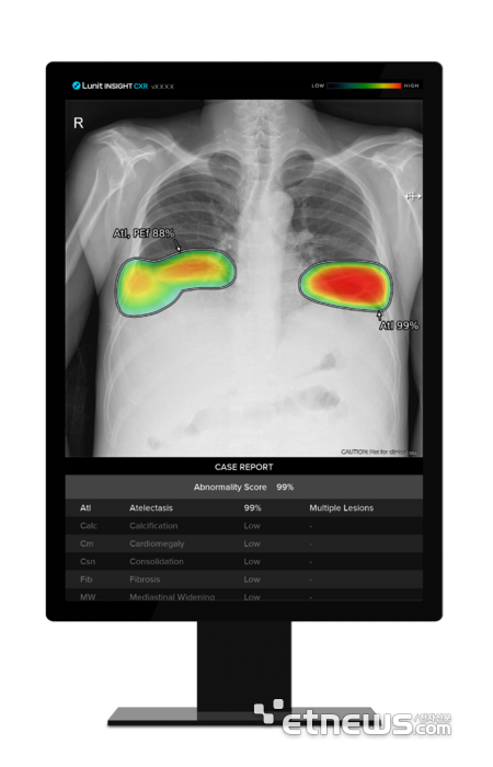 루닛 인사이트 CXR