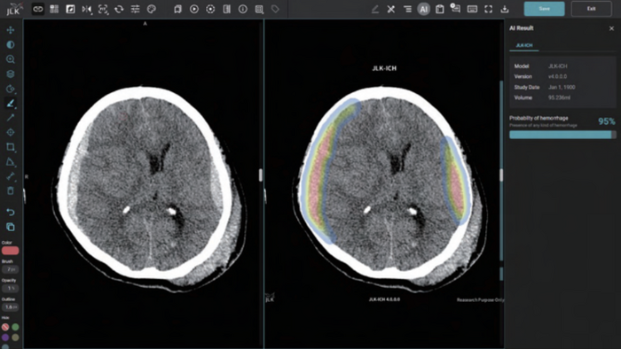 제이엘케이 뇌출혈 검출 솔루션 'JLK-ICH'(사진=제이엘케이)
