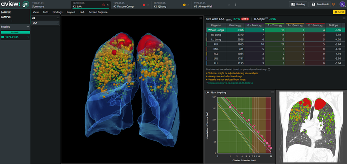 코어라인소프트의 만성폐쇄성폐질환(COPD) 진단 소프트웨어 에이뷰 씨오피디(사진=코어라인소프트)