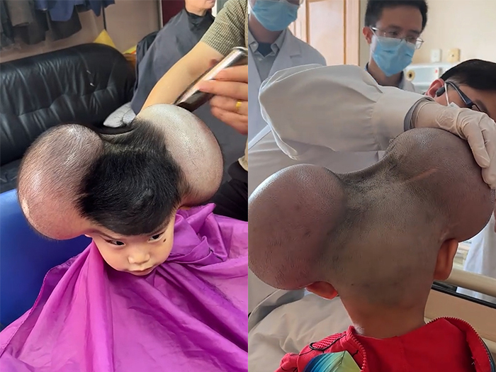 희귀질환 때문에 '미키마우스'라는 별명을 얻은 中 어린이의 사연