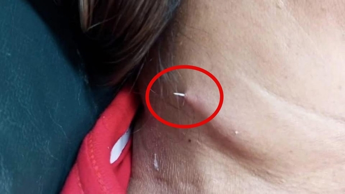 잘못 삼킨 생선가시… 2주 뒤 목 뚫고 나왔다