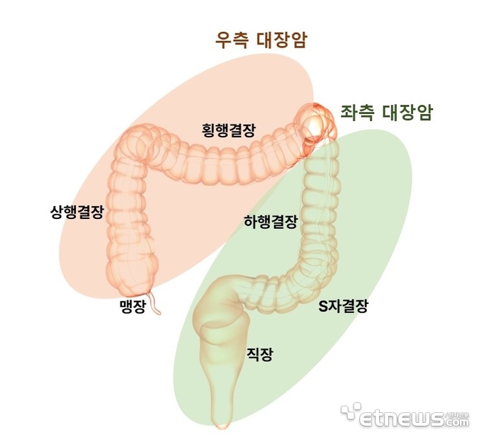 정면에서 바라본 대장암의 위치별 분류(제공=분당서울대병원)