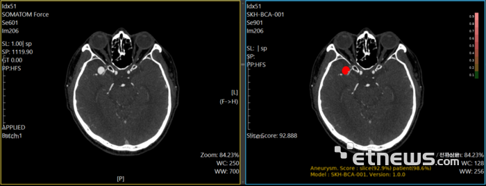 퍼플에이아이, 뇌동맥류 진단 AI 솔루션 식약처 의료기기 허가 - 뉴스 썸네일 이미지