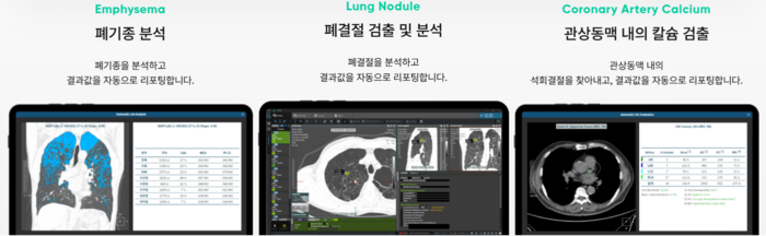 코어라인소프트 흉부 영상 분석 소프트웨어 에이뷰 LCS 플러스(사진=코어라인소프트)