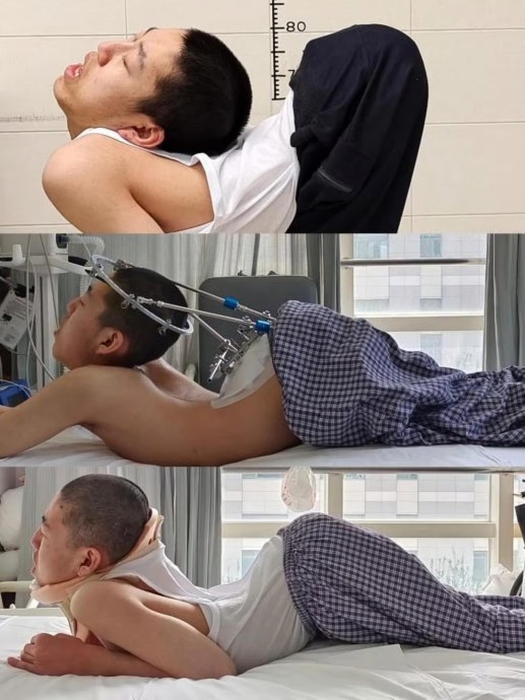 중국 '폴더 소년'의 몸이 수술을 거듭하면서 점점 펴지고 있다. 사진=사우스차이나모닝포스트 캡처