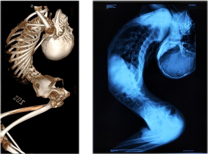 중국 '폴더 소년' 척추 변형 상태. 사진=사우스차이나모닝포스트 캡처