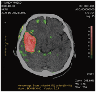 퍼플에이아이의 뇌출혈 진단 보조 AI(사진=퍼플에이아이)