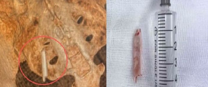 22년 동안 몸속에 박혀 있었다는 이것, “학창시절에…”