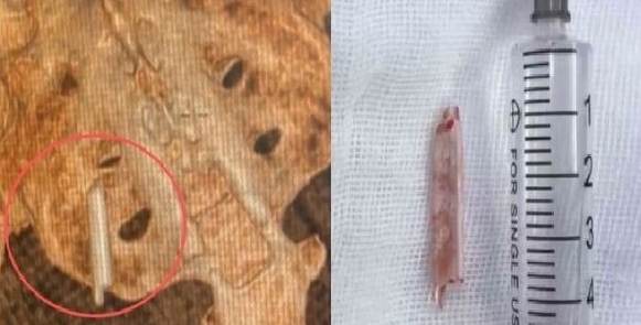 여성의 엉덩이에서 발견된 유리 체온계 조각. 사진=광명일보