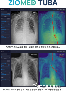 지오비전 'ZioMED TUBA'