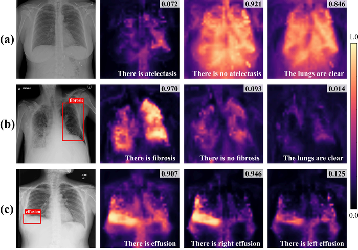 비전-언어 모델이 흉부 X-ray와 판독문의 관계를 학습해 유사도를 확률값으로 표현한 모습(사진=딥노이드)