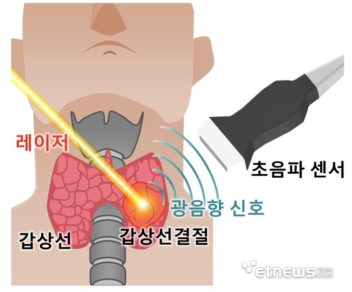 갑상선 결절에 레이저로 광음향 신호를 발생시키고 초음파 센서로 광음향 신호를 획득하는 모식도