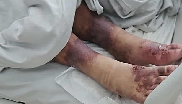 27년 전 실종된 것으로 알려진 미렐라의 다리. 발목 근처가 괴사한 것처럼 변색돼 있고 다리가 부어있다. 사진=아이리시썬 캡처