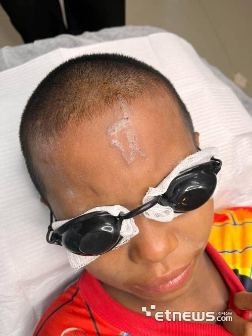 태국의 10살 소년 카오가 동급생들이 급조한 문신 기구를 사용해 새긴 이마 문신을 제거하는 시술을 받는 모습. 〈사진=페이스북 캡처〉