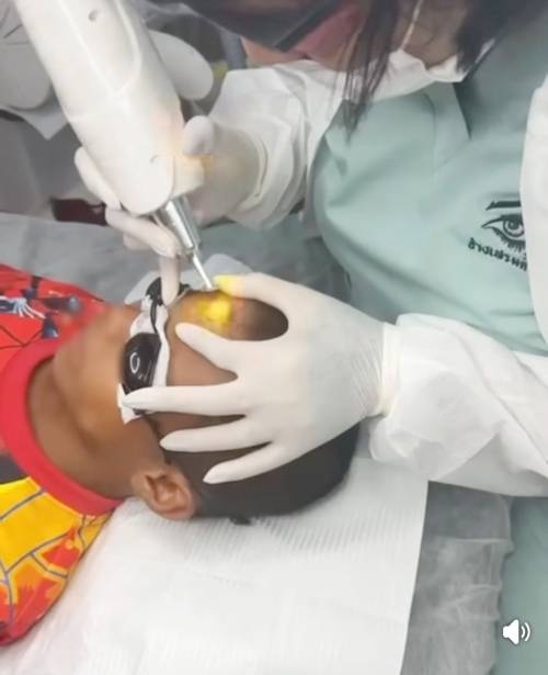 태국의 한 문신 전문가가 10살 소년 카오의 이마에 새겨진 문신을 제거하는 레이저 시술을 하고 있다. 〈사진=페이스북 캡처〉