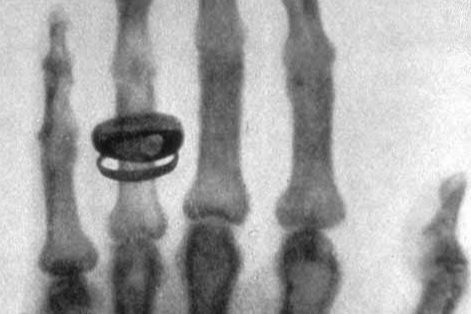 알베르트 폰 켈리커(Albert von Koelliker)의 왼손 X-선 사진 / Public Domain