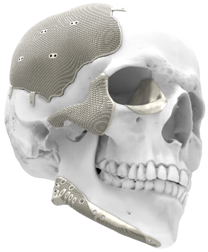 맞춤형 두개골.