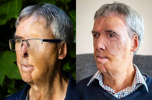 사고로 얼굴 절반 잃은 英 남성, 3D 프린팅으로 미소 되찾았다