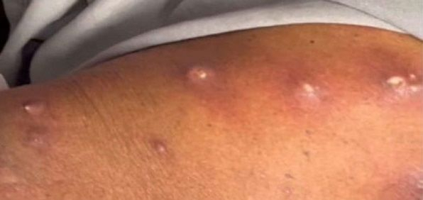 젖은 빨래에 알이 달라붙어…“사람 피부 파고든 구더기가 몸속에서 꿈틀”