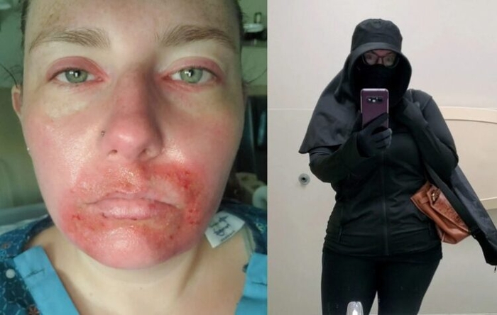 뱀파이어가 된 여성…햇빛에 30초만 노출돼도 피부 타들어가