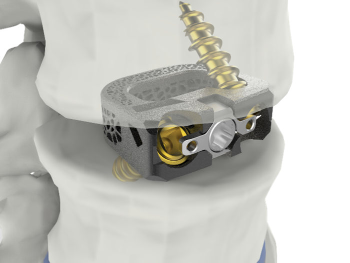 시지메드텍 척추 융합기기 '유니스페이스'(사진=시지메드텍)