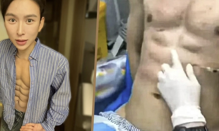 인공적으로 8팩 복근을 만들기 위해 400만위안(8억2000만원)을 썼다는 중국인 남성. 사진=SCMP 캡처