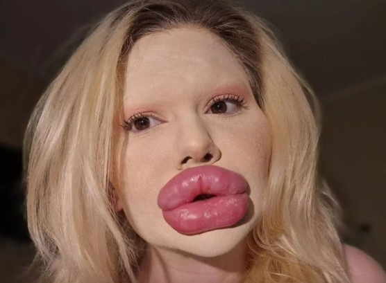 입술 필러에 3800만원 쓴 여성… 의료진마저 “진료 불가”