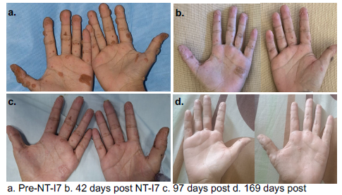 NT-I7 투여로 인한 피부 병변 개선 결과(사진=네오이뮨텍)