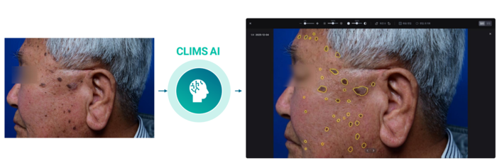 더마트릭스 피부과 임상 사진 데이터 솔루션 'CLIMS'의 AI 병변 탐지 기능(사진=더마트릭스)