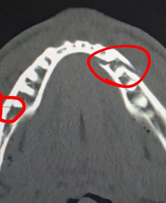 유튜버출신 복서 제이크 폴이 앤서니 조슈와의 경기로 턱뼈 부상을 입었다. 사진=인스타그램 캡처
