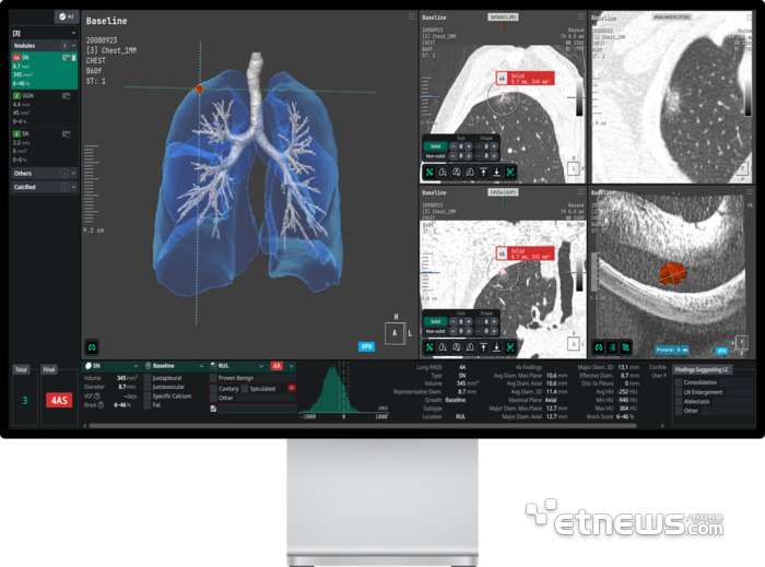 코어라인소프트 통합 흉부 AI 시스템