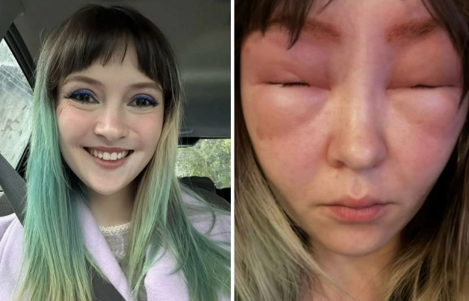 캐나다 밴쿠버에 사는 켈시 클리브(32)의 눈썹 염색 전 정상적인 모습(왼쪽)과 염색 후 심하게 부어오른 모습. 사진=인스타그램(@kelseycleave) 캡처