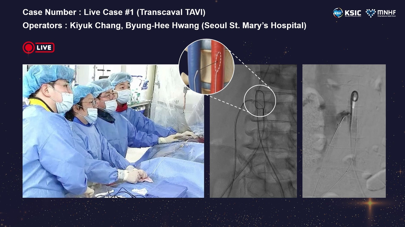 성모병원, 경대정맥 대동맥 판막 치환술 실시…국내 최초