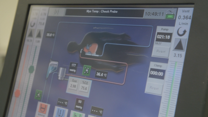 인공 폐가 폐 기능을 대체하는 동안 혈류, 산소 농도, 체온을 추적하는 모니터링 화면. 사진=Northwestern Medicine