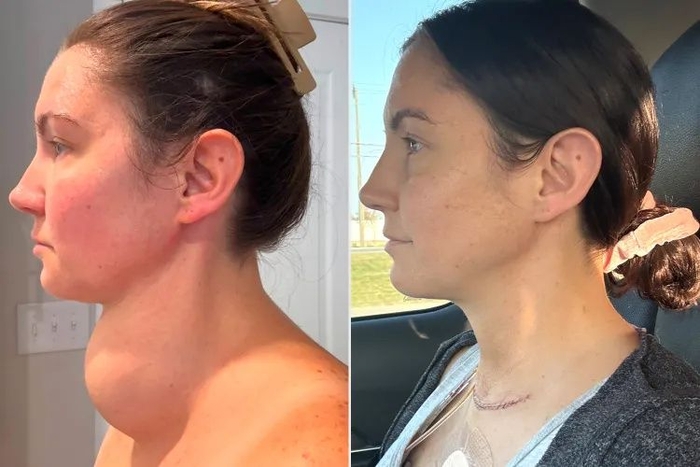 갑상선이 부풀어 오른 여성. 사진=헤더 월러스 SNS