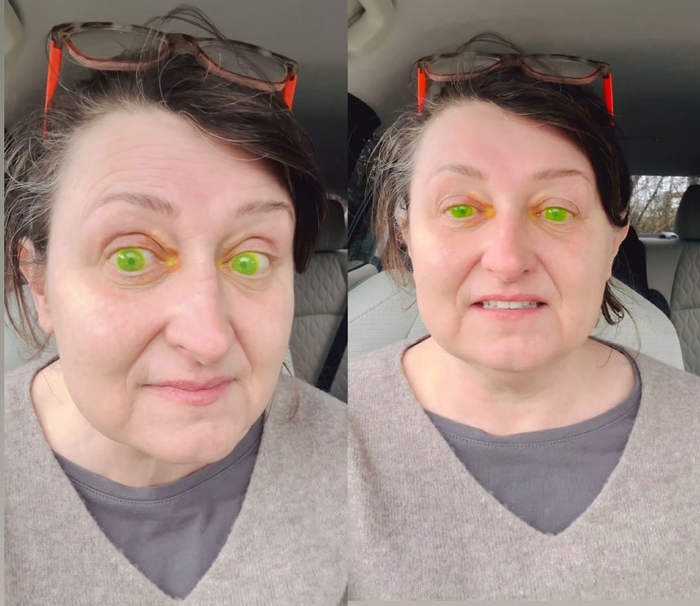 안과 검진 후 눈이 형광 녹색으로 변한 여성. 사진= 인스타그램 계정 'margoinireland' 캡쳐