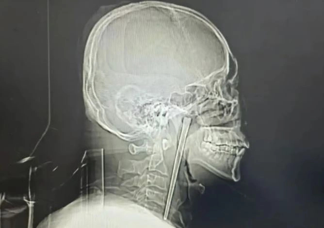 8년 전 술을 마시다 실수로 젓가락을 삼킨 왕씨의 목 엑스레이 사진에 금속 이물질이 목 안에 박혀 있는 모습이 선명하게 찍혔다. 사진=바이두