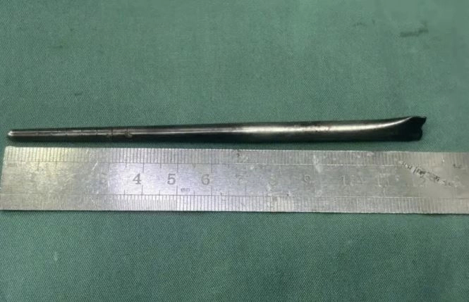 중국 남성이 삼킨 12㎝ 길이의 금속 젓가락. 사진= 바이두