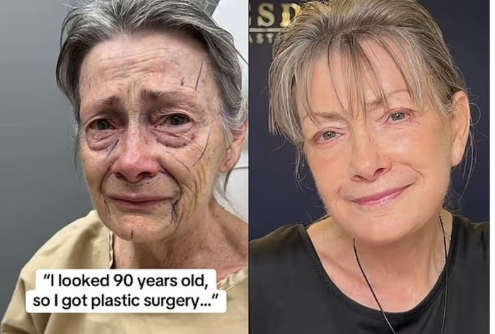 안면거상술을 받은 70세 여성의 수술 전후 모습. 사진=데일리메일