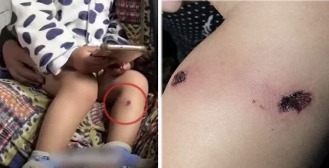 이스라엘군의 담뱃불 고문 흔적. 자료=팔레스타인 TV, 알자지라 방송