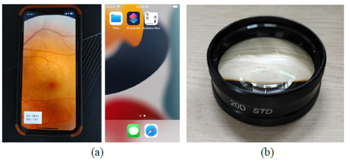 아주대 지능형 의료 영상 진단 솔루션 연구센터의 스마트폰 망막 안저 사진 분석을 통한 알츠하이머 병의 유무 진단 기술(사진=아주대 지능형 의료 영상 진단 솔루션 연구센터)