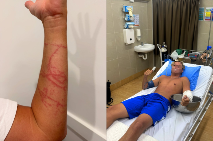 상자해파리 일종인 이루칸지 해파리에 쏘인 호주 서퍼 가이 로울스. 사진=인스타그램(@guy_rowles) 캡처