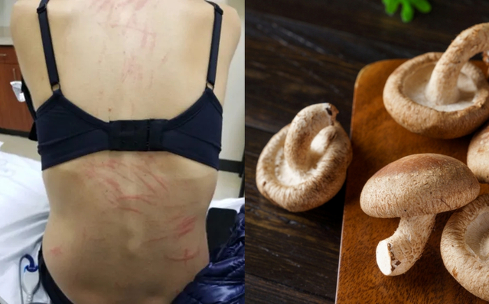 표고버섯 피부염(Shiitake Dermatitis) 증상과 표고버섯. 사진=JETem / 게티이미지뱅크
